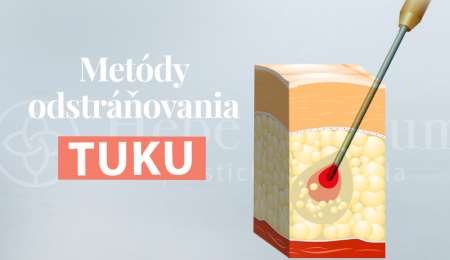 metody-odstranovania-tuku4.jpg