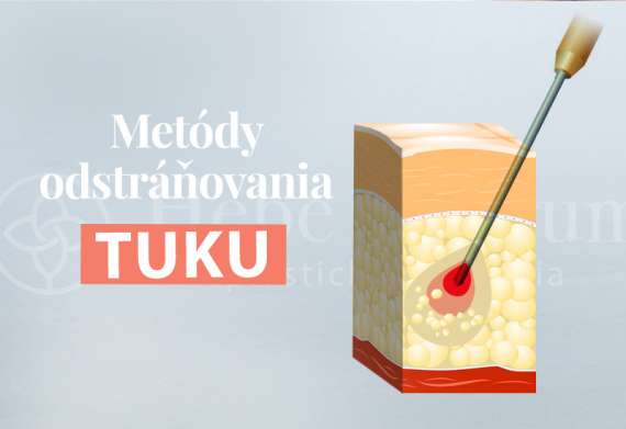 metody-odstranovania-tuku4.jpg