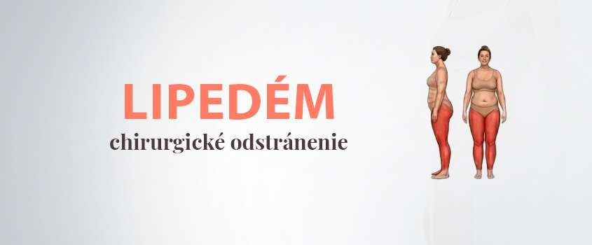 lipedem-liposukcia.jpg