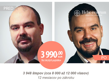 cena za transplantaciu vlasov
