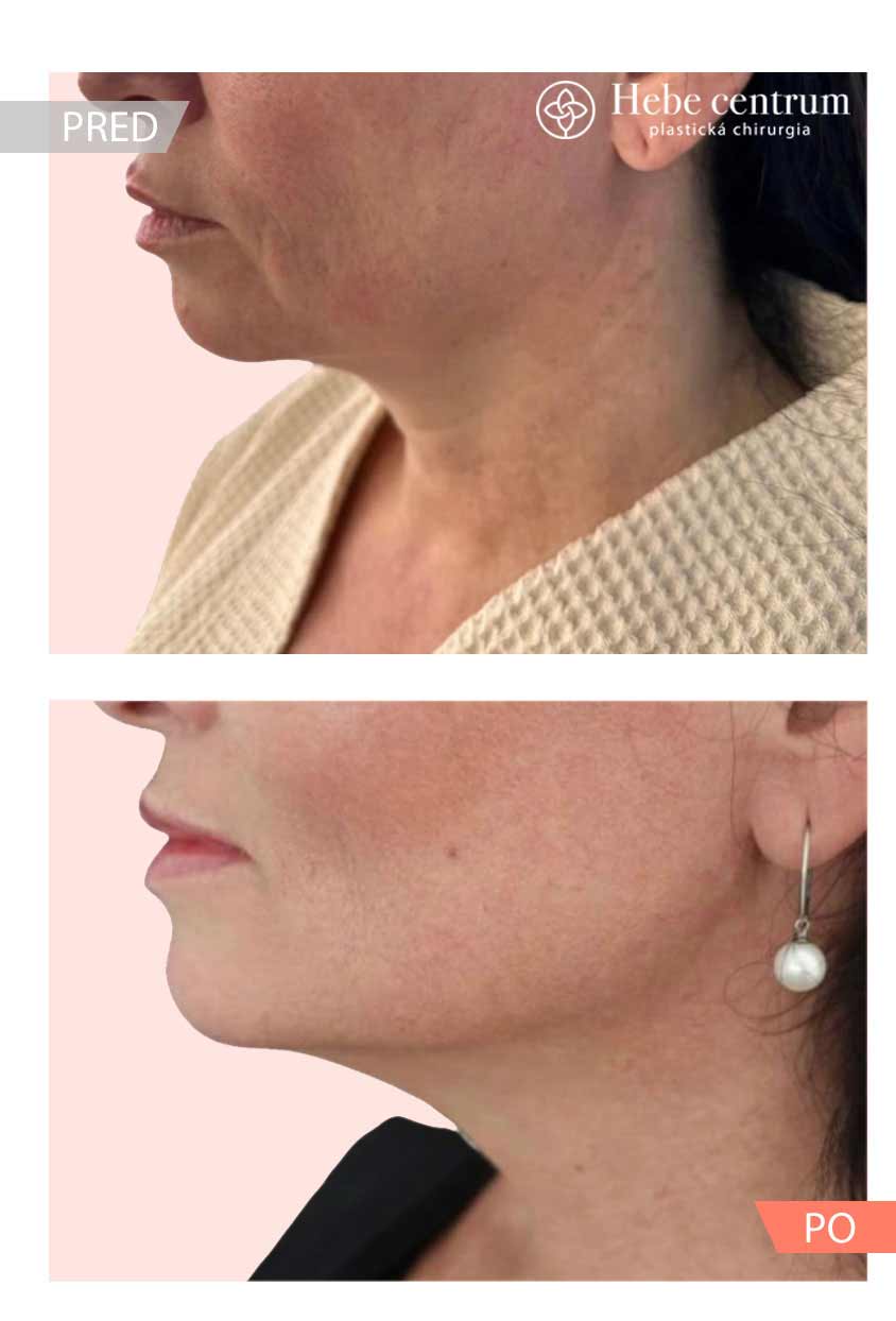 Klient zákrok Morpheus8 - MUDr. Nasab