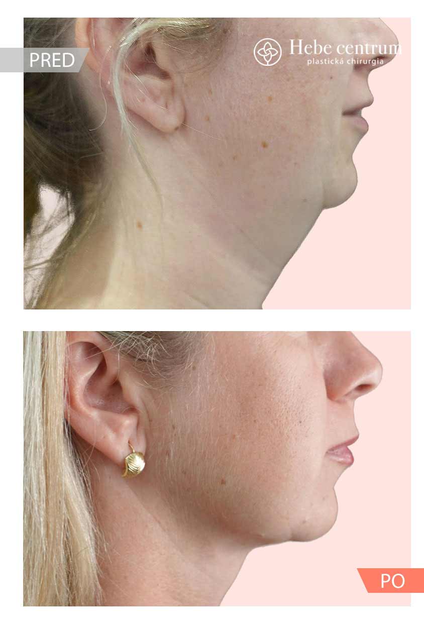 Morpheus8 klient výsledok