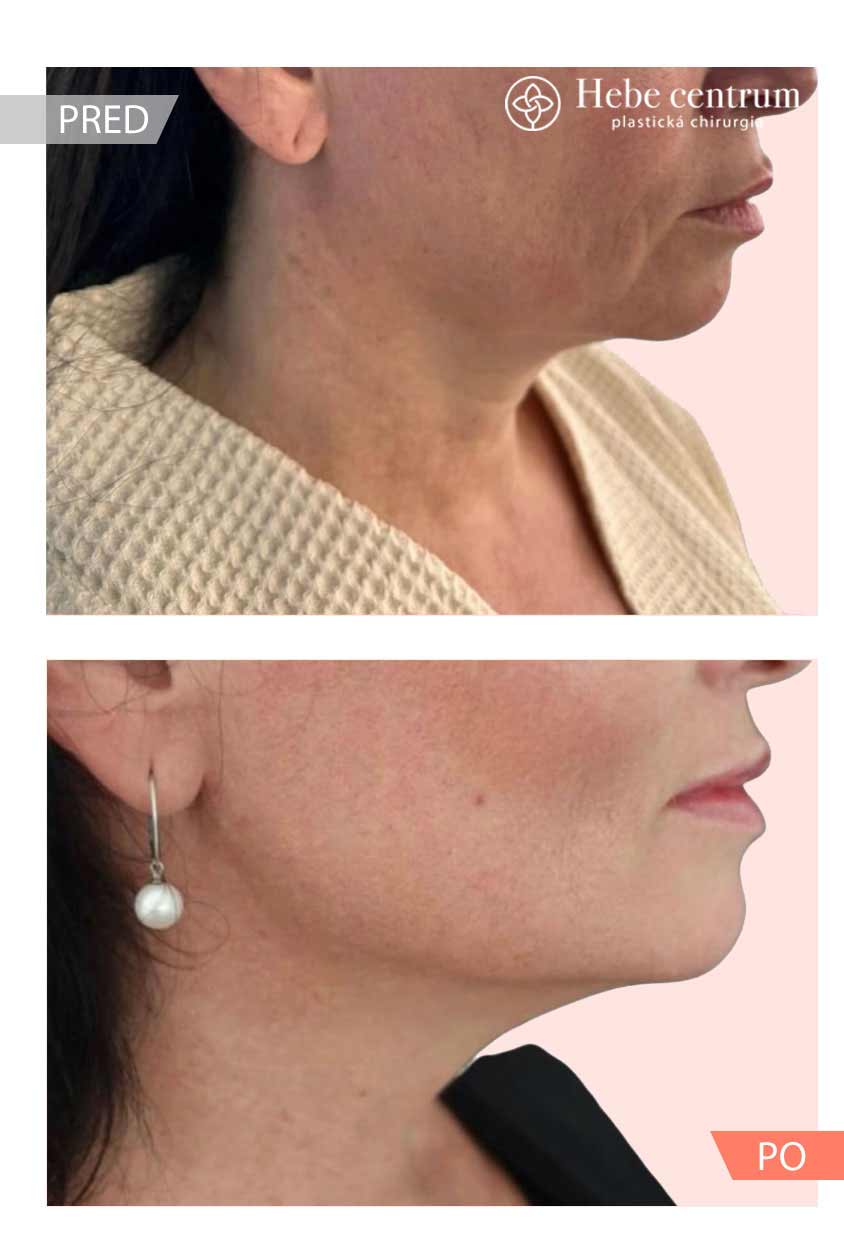 Účinky Morpheus8 výsledok operácie