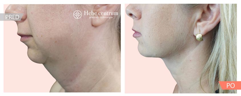 Vhodný klient na Morpheus8 pred a po zákroku