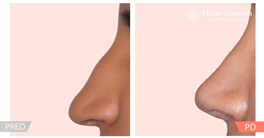 Rhinoplastika pred a po operácii