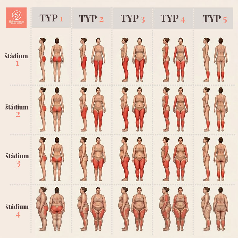 tabula typ a štádia lipedému