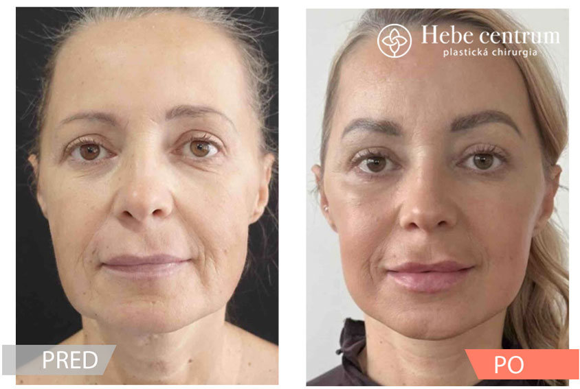 deep plane facelift deep plane neck lift a deep plane brow lift