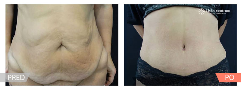 abdominoplastika-pred-a-po-3.jpg