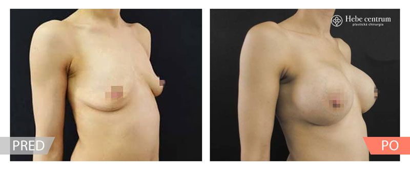 Zväčšenie prsníkov Pred a po foto
