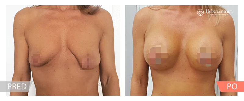 Zväčšenie prsníkov s tuberóznou deformitou