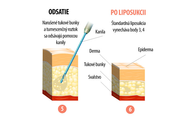 Tumescenčná liposukcia infografika