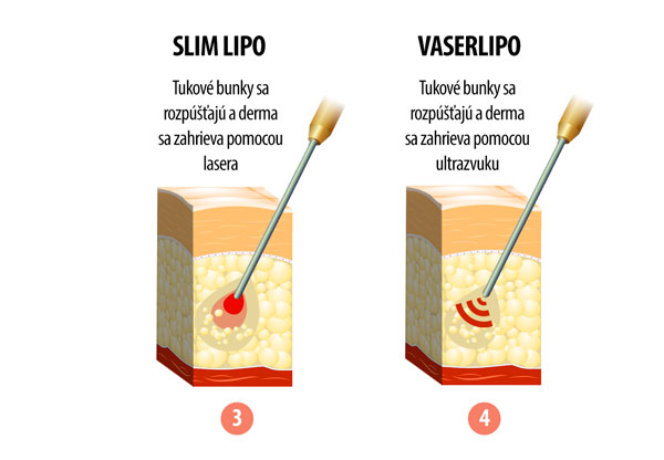 porovnanie metód liposukcie 