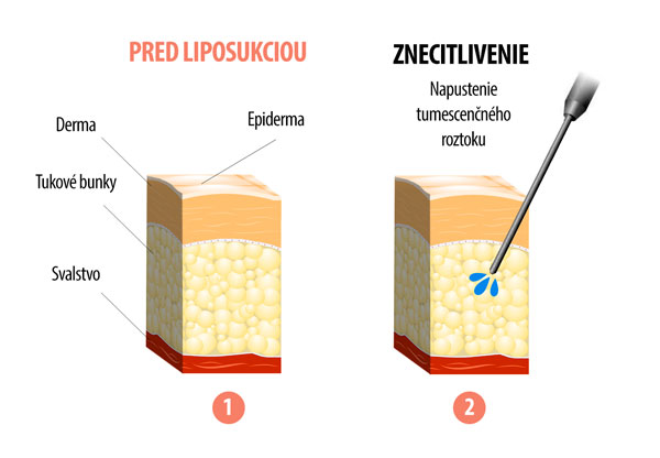 Infografika pred liposukciou