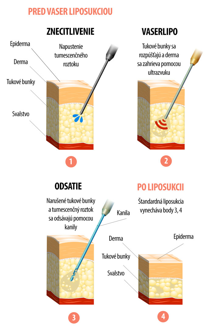 Diagram metódy VaserLipo