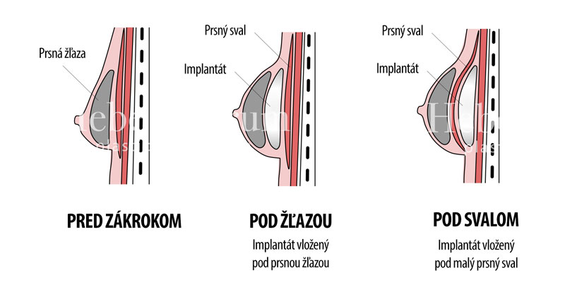 sposoby-vlozenia-implantatov-1.jpg