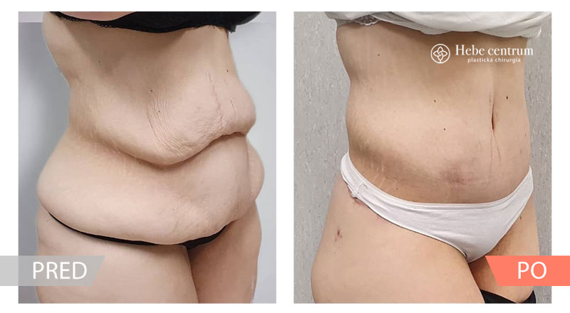 lipoabdominoplastika pred a po zákrokom