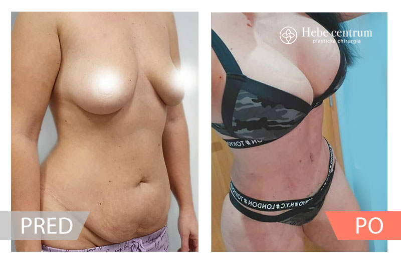 augmentácia prsníkov s abdominoplastikou a slimlipo pred a po zákroku