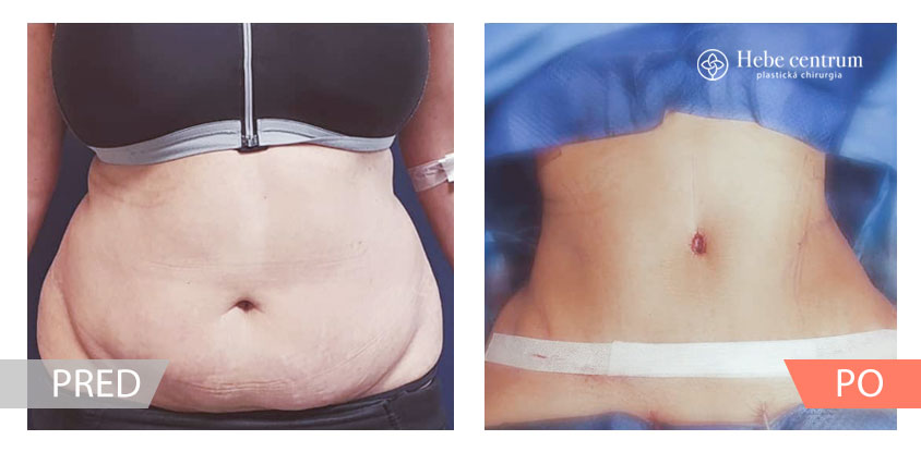 vysledok lipoabdominoplastiky