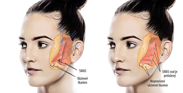 diagram smas facelift