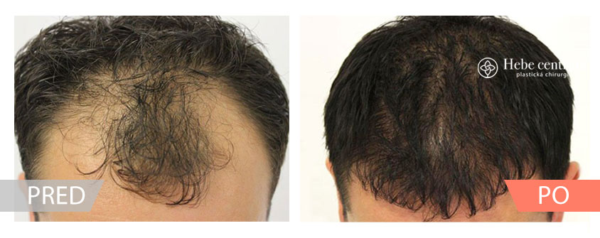 transplantacia vlasov pred a po fotky