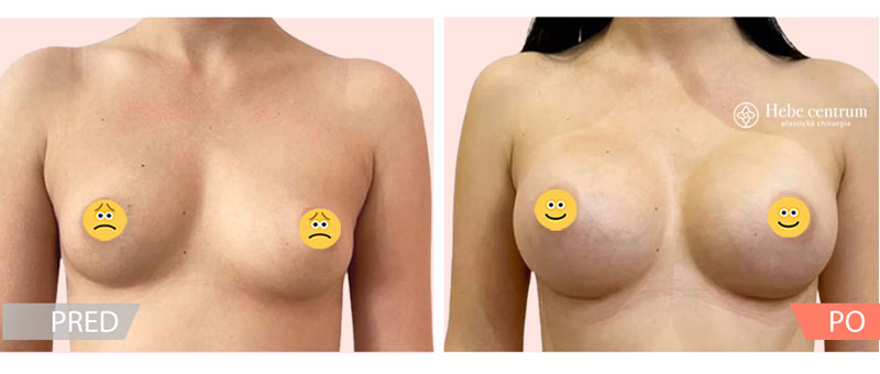 pred a po zvacsenie prs