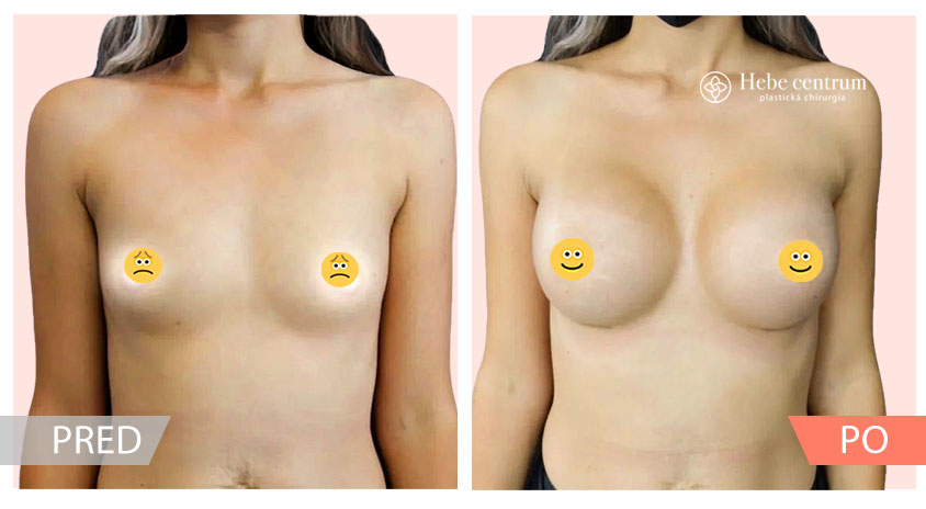 zvacsenie prs pred a po fotky